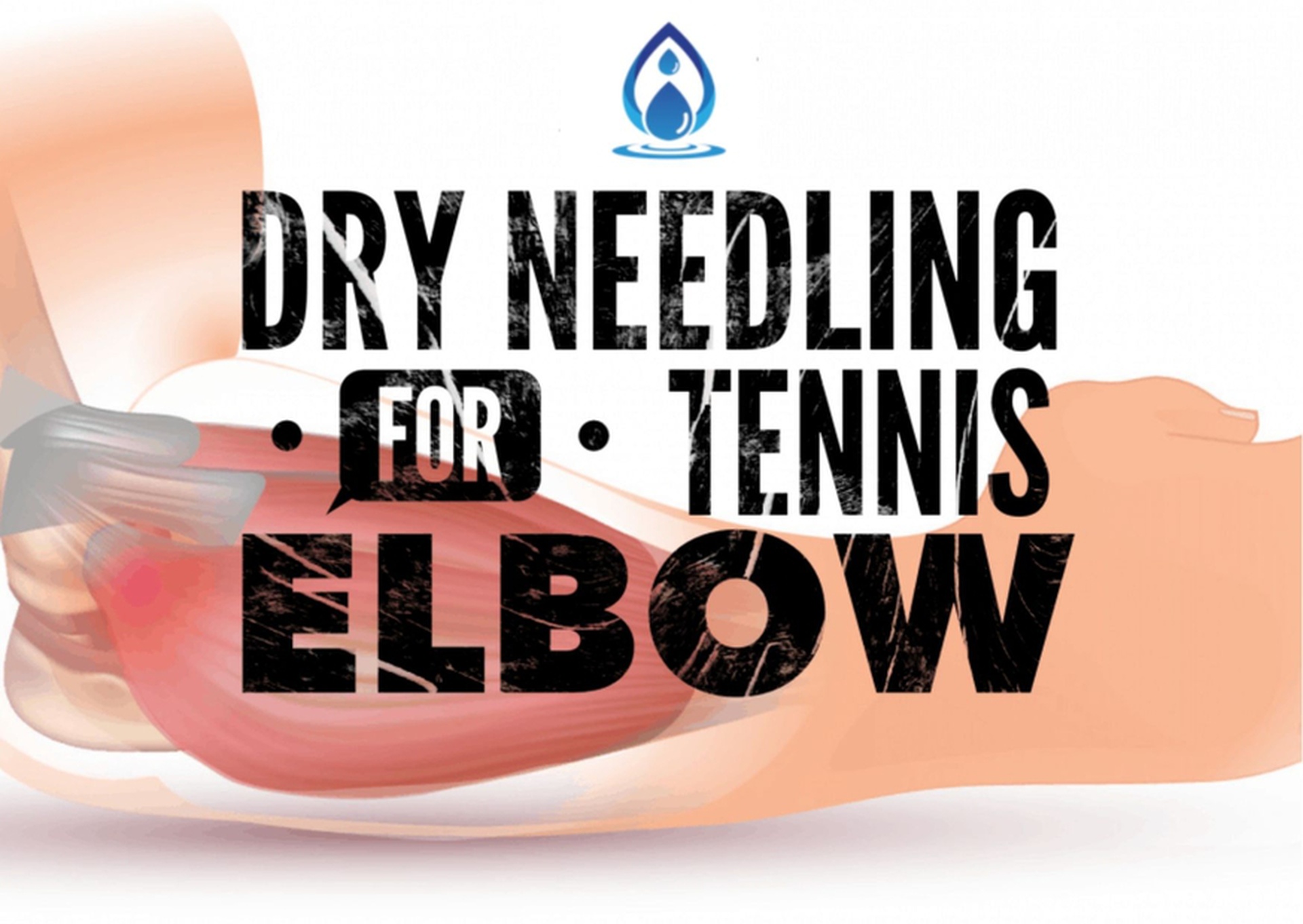 A Comprehensive Guide to Dry Needling for Tennis Elbow