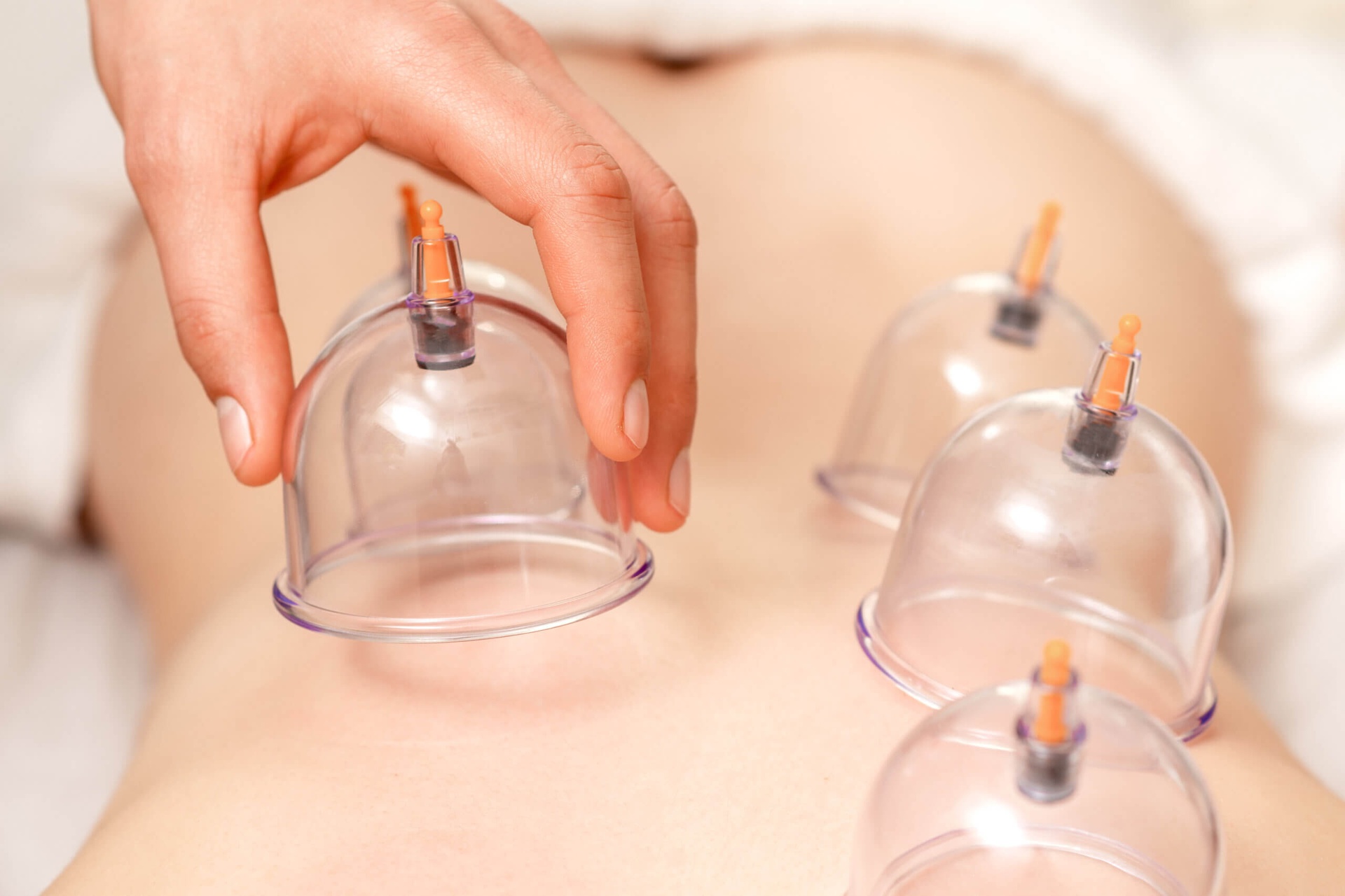 what to expect after cupping therapy explore the effects