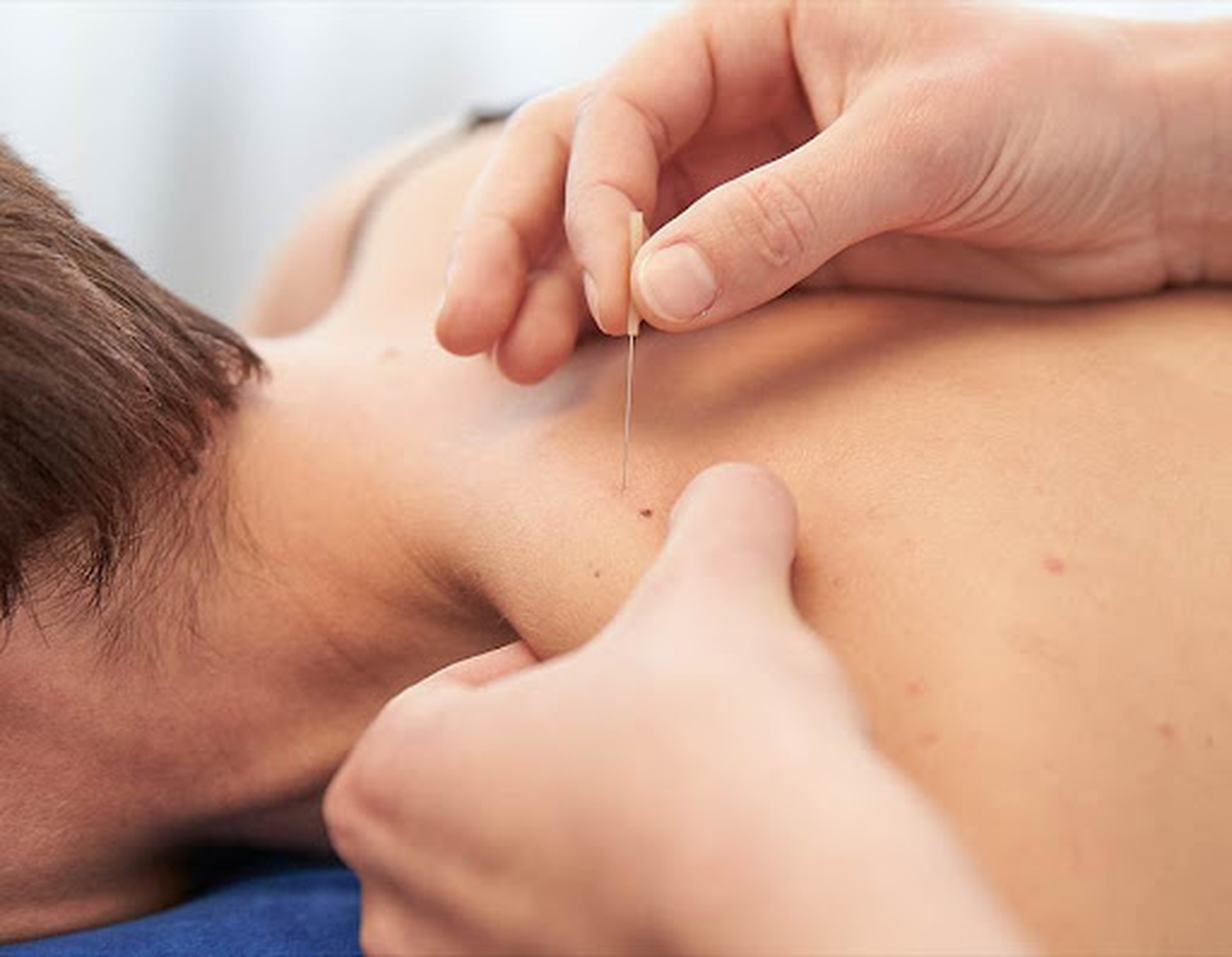 Good-effect-of-dry-needling