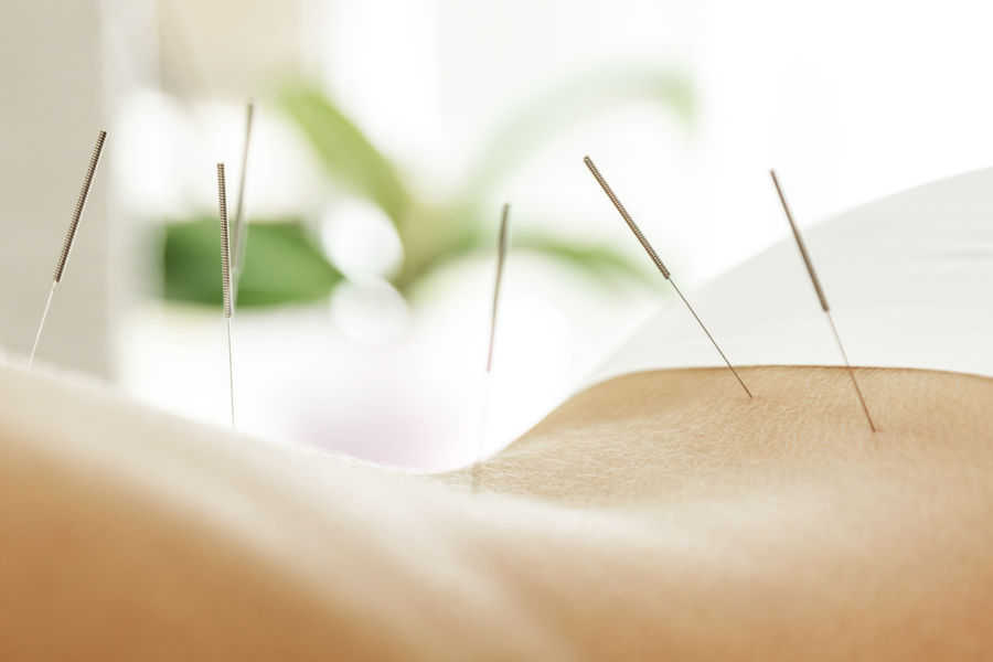 dry-needling